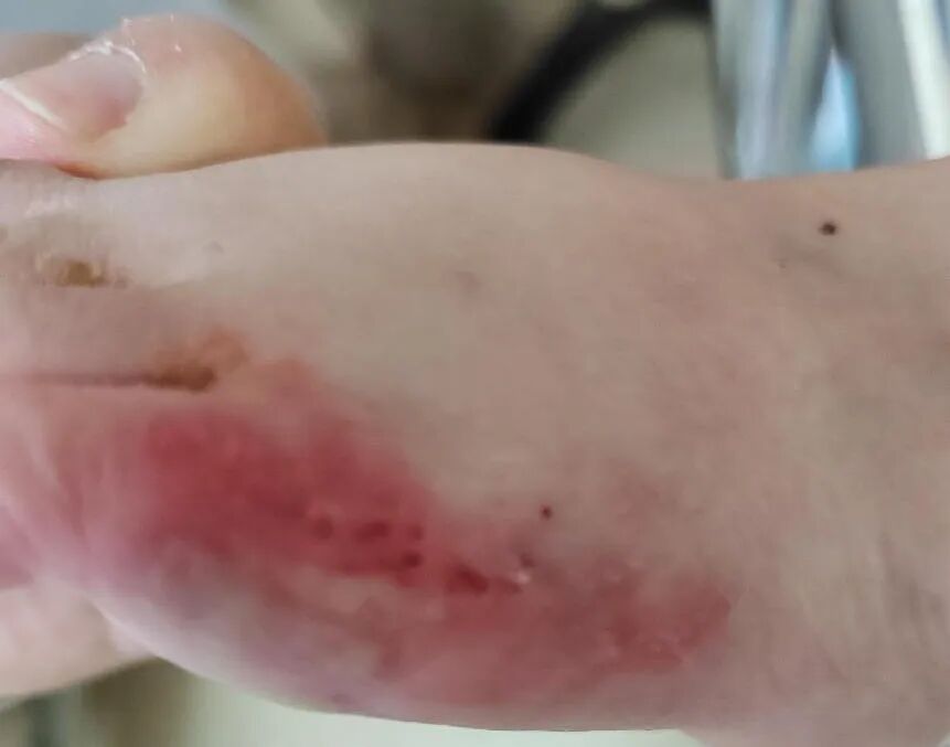 医用弹力绷带怎么取弹力绷带竟有严重并发症，护士千万要注意！_https://www.jmylbn.com_新闻资讯_第3张