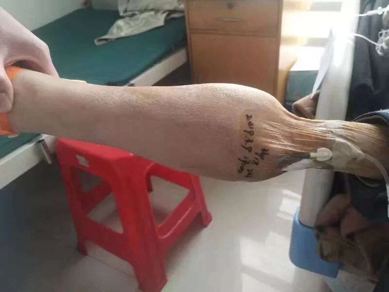 弹力绷带怎么固定弹力绷带固定留置针竟有如此严重并发症，护士千万要注意！_https://www.jmylbn.com_新闻资讯_第2张