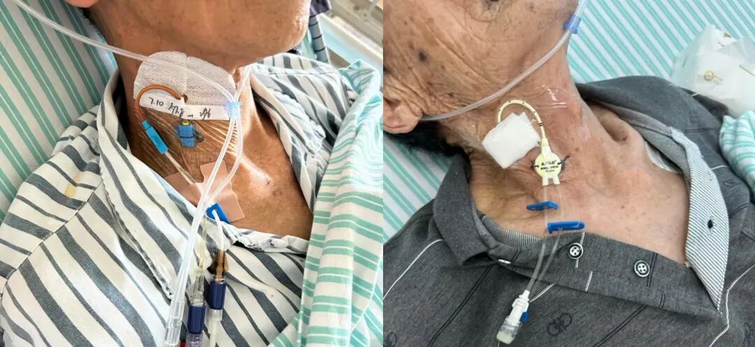 医用缝合扣怎么用CVC 卡扣必须缝皮肤上？一文说清「缝合」与「无缝合」固定！_https://www.jmylbn.com_新闻资讯_第6张