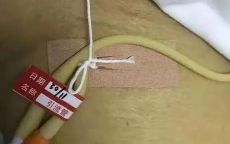 尿管怎么固定导尿管二次固定总是松脱？一招轻松解决！_https://www.jmylbn.com_新闻资讯_第3张