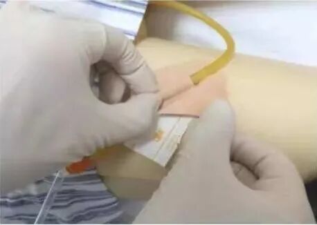 尿管怎么固定导尿管二次固定总是松脱？一招轻松解决！_https://www.jmylbn.com_新闻资讯_第2张