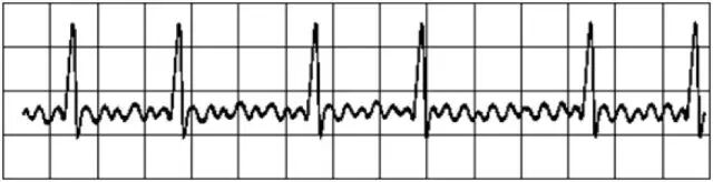 为什么选择双相波【规培指导】临床实用的心脏电复律29个问题解读_https://www.jmylbn.com_新闻资讯_第5张