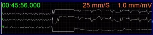 为什么选择双相波【规培指导】临床实用的心脏电复律29个问题解读_https://www.jmylbn.com_新闻资讯_第4张