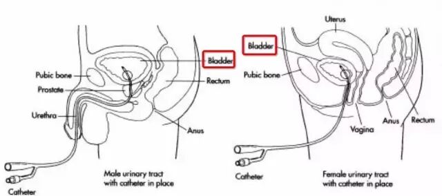 为什么要引流尿袋留置尿管到底几天更换一次？见尿为何要再插入？_https://www.jmylbn.com_新闻资讯_第4张