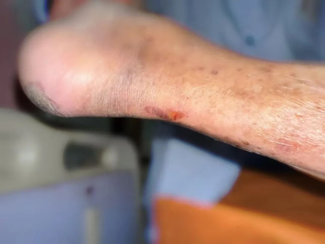 什么病忌用翻身床为什么医生特意强调不能翻身，护士：那皮肤压疮不查了？_https://www.jmylbn.com_新闻资讯_第5张