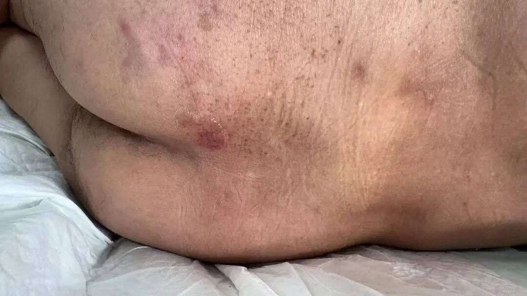 什么病忌用翻身床为什么医生特意强调不能翻身，护士：那皮肤压疮不查了？_https://www.jmylbn.com_新闻资讯_第3张