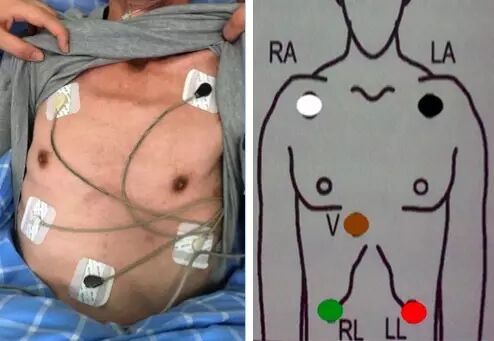 心电监护怎么贴三导联及五导联有何区别？安放电极片的 7 个「讲究」_https://www.jmylbn.com_新闻资讯_第4张