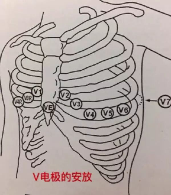 心电监护怎么贴三导联及五导联有何区别？安放电极片的 7 个「讲究」_https://www.jmylbn.com_新闻资讯_第7张
