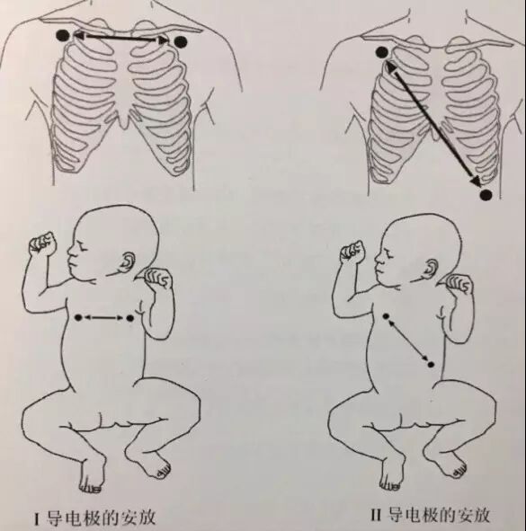 心电监护怎么贴三导联及五导联有何区别？安放电极片的 7 个「讲究」_https://www.jmylbn.com_新闻资讯_第8张