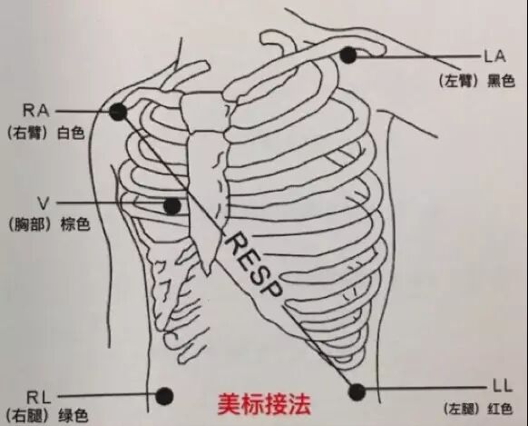 心电监护怎么贴三导联及五导联有何区别？安放电极片的 7 个「讲究」_https://www.jmylbn.com_新闻资讯_第5张