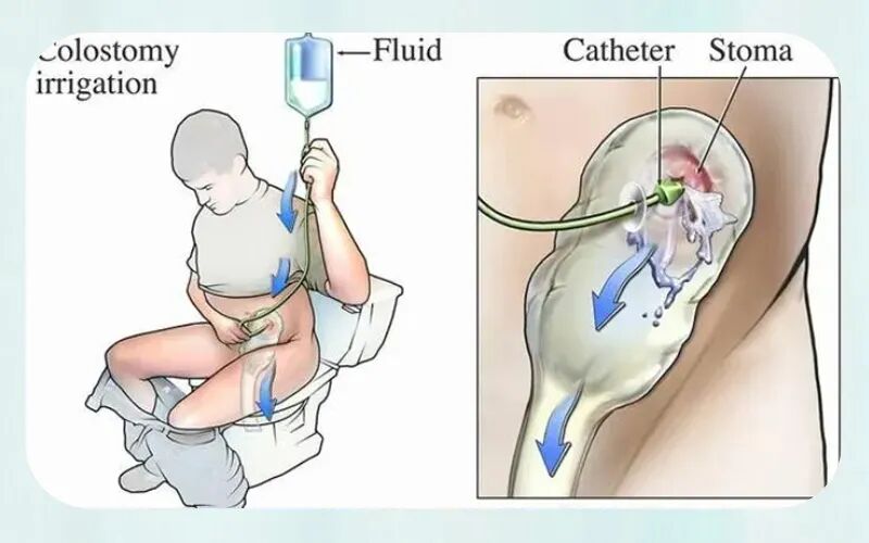 结肠灌洗怎么回事结肠造口患者如何给予灌肠？_https://www.jmylbn.com_新闻资讯_第7张
