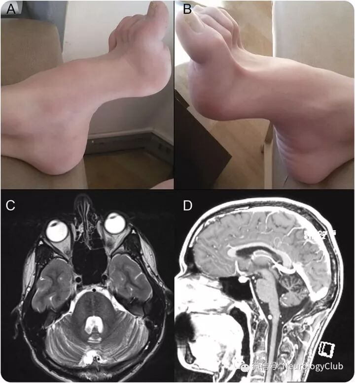 年轻男性 弓形足 痉挛性共济失调 神经病学俱乐部
