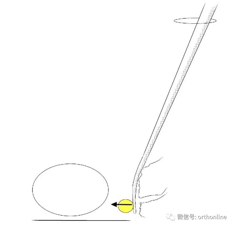 剥离子怎么使用临床必备 ｜ UBE神经剥离子的选择和使用_https://www.jmylbn.com_新闻资讯_第5张