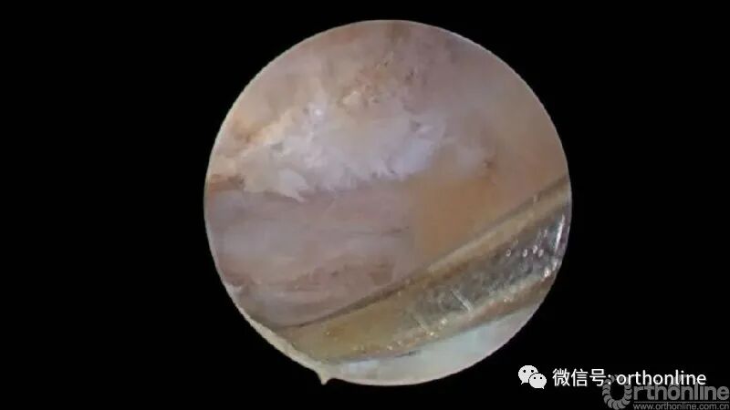 剥离子怎么使用临床必备 ｜ UBE神经剥离子的选择和使用_https://www.jmylbn.com_新闻资讯_第6张