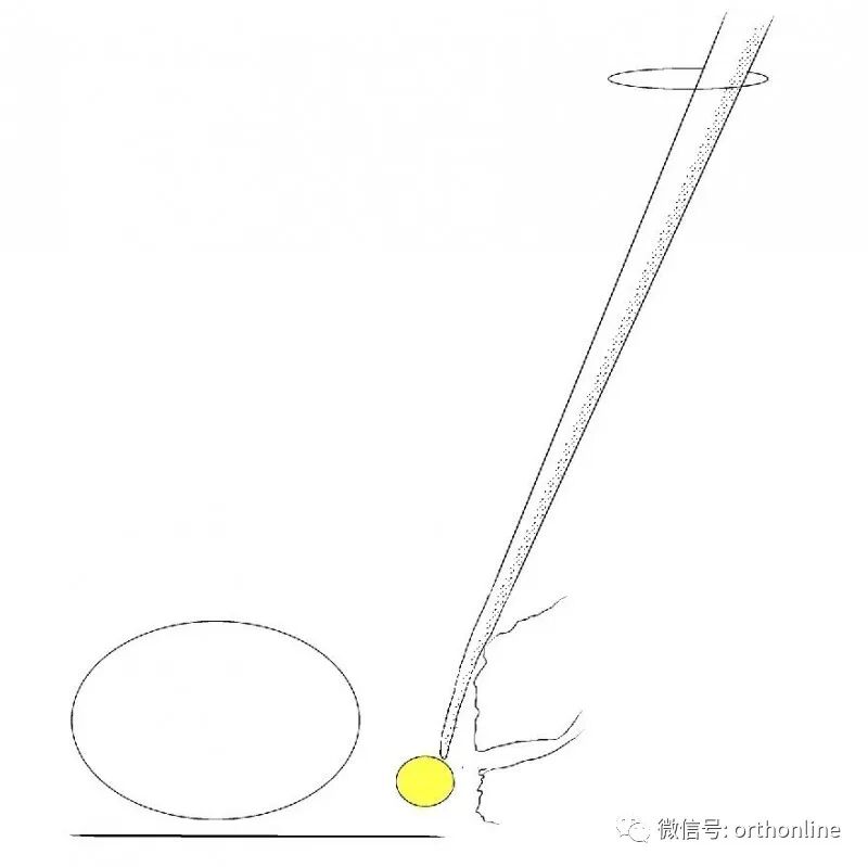 剥离子怎么使用临床必备 ｜ UBE神经剥离子的选择和使用_https://www.jmylbn.com_新闻资讯_第3张