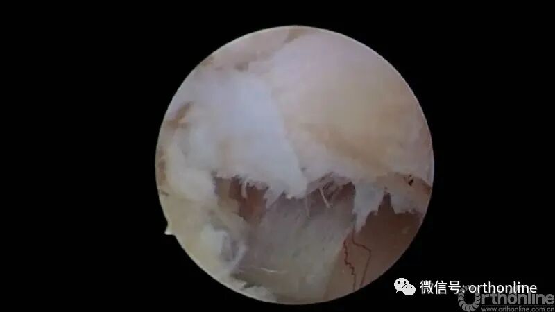 剥离子怎么使用临床必备 ｜ UBE神经剥离子的选择和使用_https://www.jmylbn.com_新闻资讯_第8张