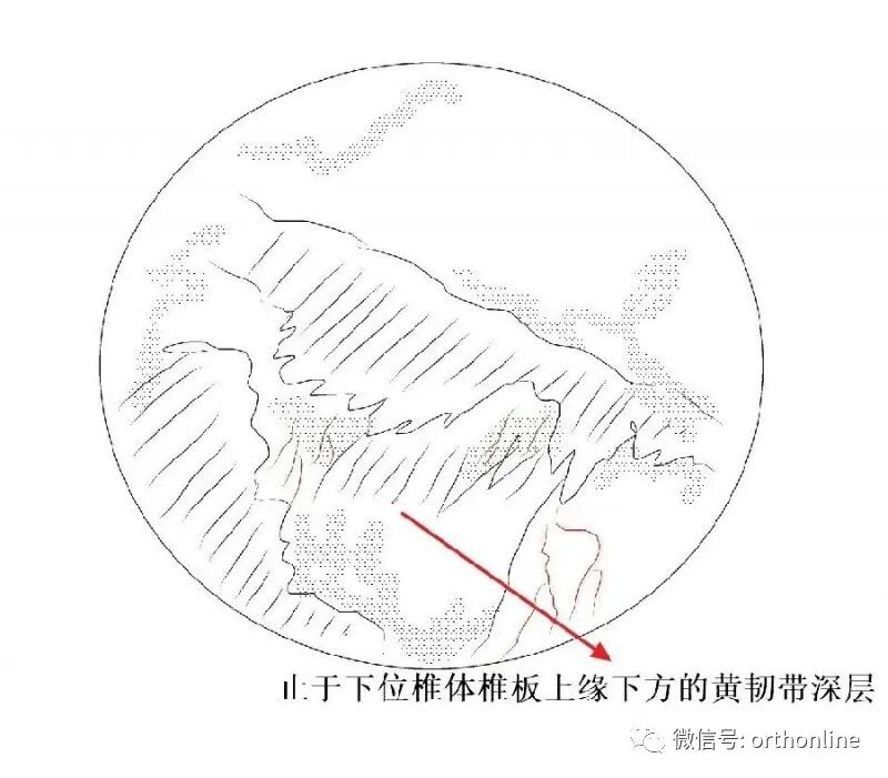 剥离子怎么使用临床必备 ｜ UBE神经剥离子的选择和使用_https://www.jmylbn.com_新闻资讯_第9张