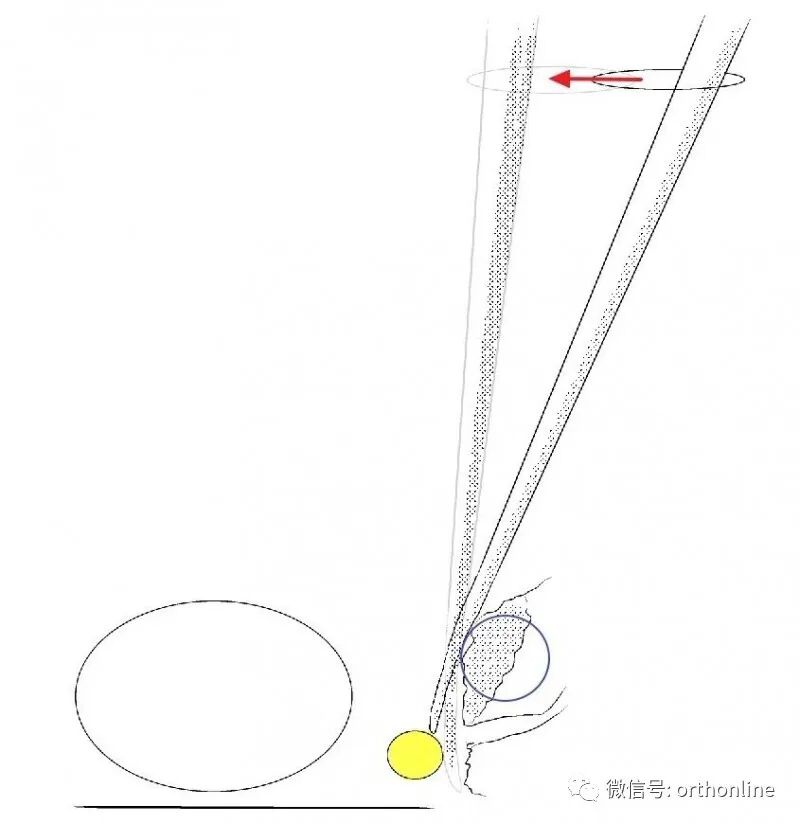 剥离子怎么使用临床必备 ｜ UBE神经剥离子的选择和使用_https://www.jmylbn.com_新闻资讯_第4张