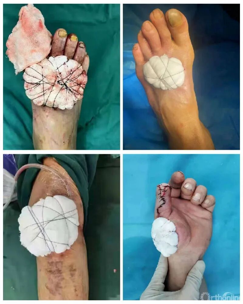 医用缝合包怎么包干货 ｜ 手把手教你缝合打包跨供区加压法修复皮肤软组织缺损_https://www.jmylbn.com_新闻资讯_第5张