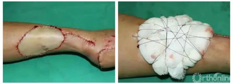 医用缝合包怎么包干货 ｜ 手把手教你缝合打包跨供区加压法修复皮肤软组织缺损_https://www.jmylbn.com_新闻资讯_第6张