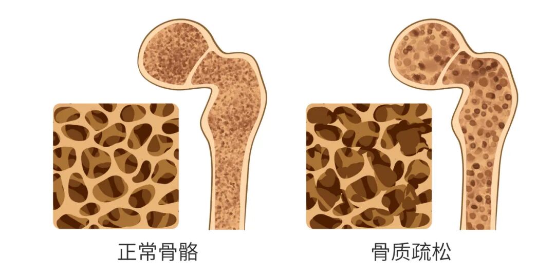 HA是什么螺钉骨质疏松患者脊柱内固定失败预防策略的研究进展-上海聚慕医疗器械有限公司