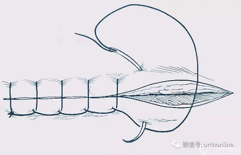 医疗缝线怎么做动图+视频，详解常见手术切口缝合技术_https://www.jmylbn.com_新闻资讯_第14张