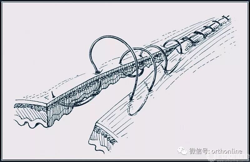 医疗缝线怎么做动图+视频，详解常见手术切口缝合技术_https://www.jmylbn.com_新闻资讯_第33张