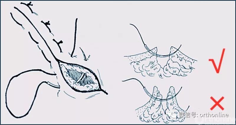 医疗缝线怎么做动图+视频，详解常见手术切口缝合技术_https://www.jmylbn.com_新闻资讯_第28张