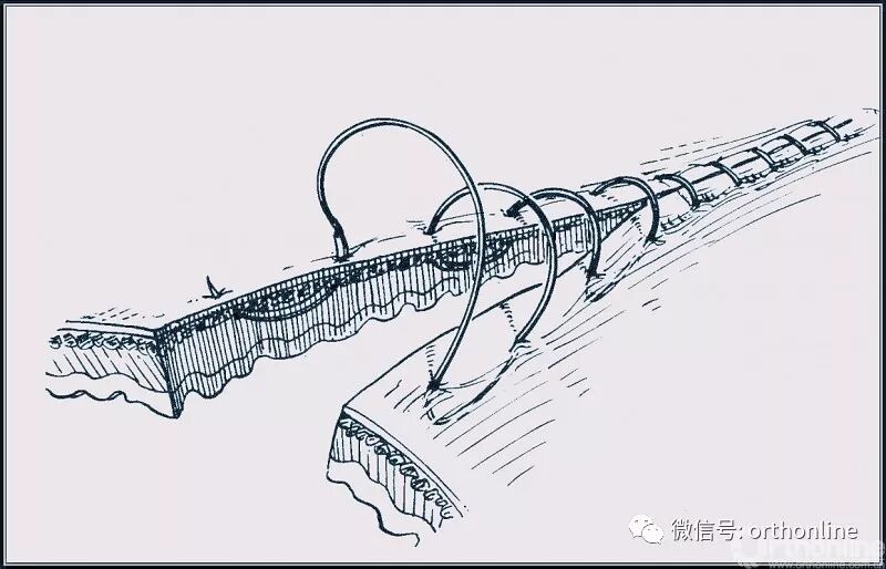 医疗缝线怎么做动图+视频，详解常见手术切口缝合技术_https://www.jmylbn.com_新闻资讯_第34张