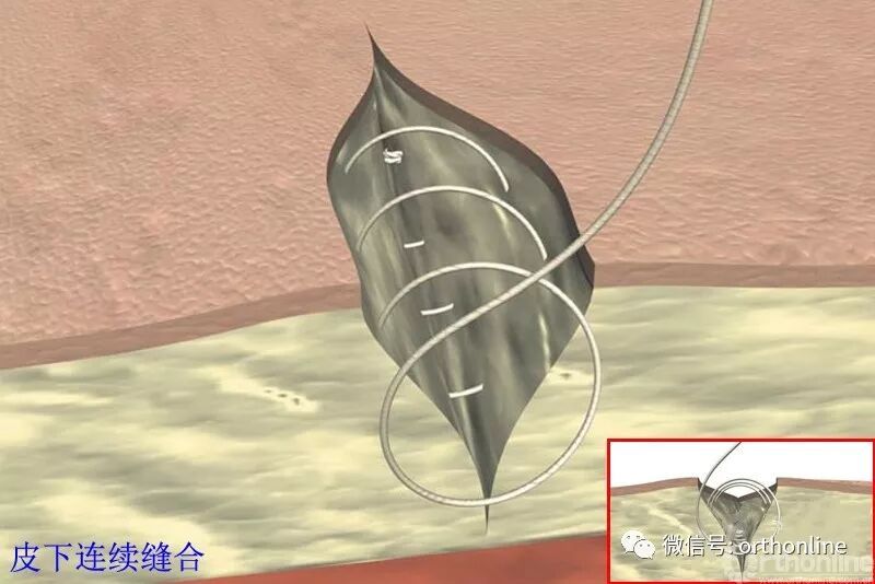 医疗缝线怎么做动图+视频，详解常见手术切口缝合技术_https://www.jmylbn.com_新闻资讯_第19张