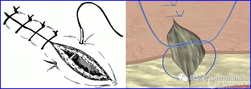 医疗缝线怎么做动图+视频，详解常见手术切口缝合技术_https://www.jmylbn.com_新闻资讯_第10张