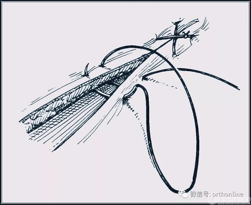 医疗缝线怎么做动图+视频，详解常见手术切口缝合技术_https://www.jmylbn.com_新闻资讯_第16张