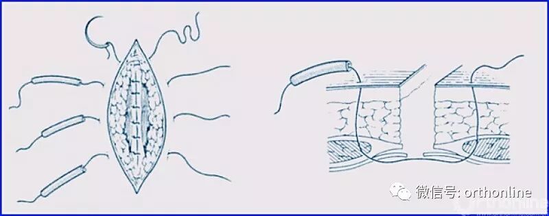 医疗缝线怎么做动图+视频，详解常见手术切口缝合技术_https://www.jmylbn.com_新闻资讯_第23张