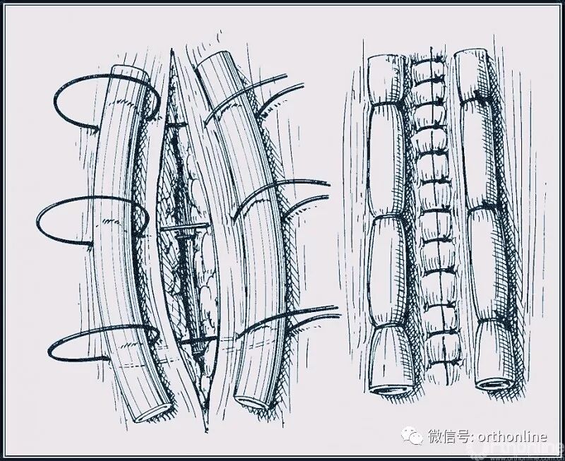 医疗缝线怎么做动图+视频，详解常见手术切口缝合技术_https://www.jmylbn.com_新闻资讯_第24张