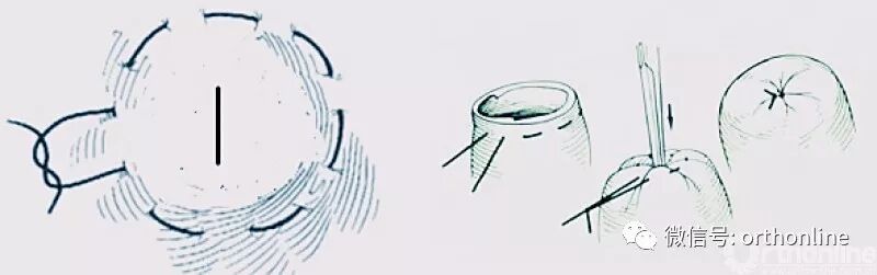 医疗缝线怎么做动图+视频，详解常见手术切口缝合技术_https://www.jmylbn.com_新闻资讯_第35张