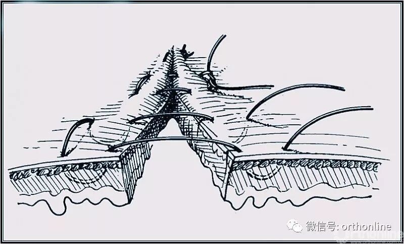 医疗缝线怎么做动图+视频，详解常见手术切口缝合技术_https://www.jmylbn.com_新闻资讯_第32张