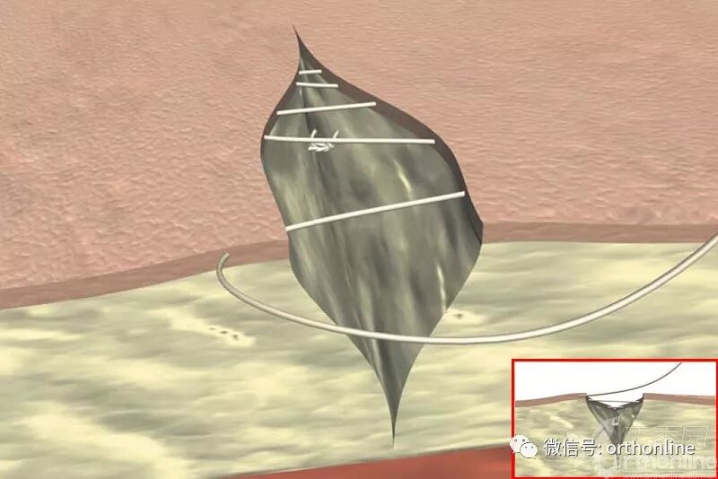 医疗缝线怎么做动图+视频，详解常见手术切口缝合技术_https://www.jmylbn.com_新闻资讯_第21张