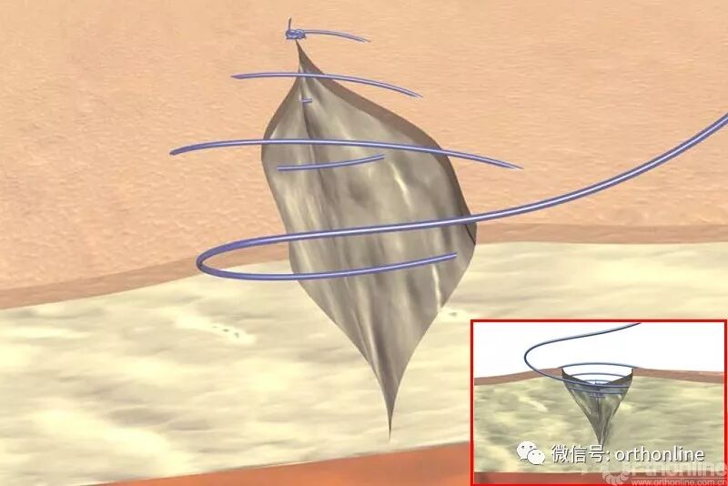 医疗缝线怎么做动图+视频，详解常见手术切口缝合技术_https://www.jmylbn.com_新闻资讯_第12张
