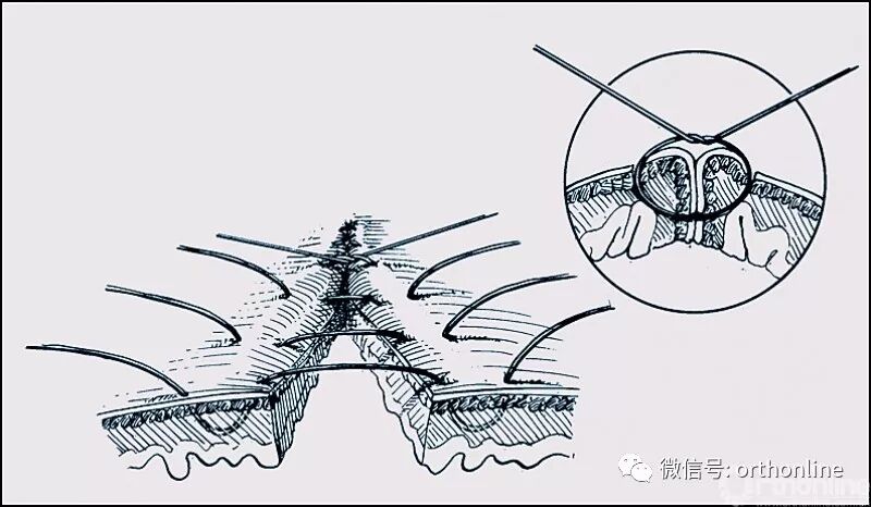 医疗缝线怎么做动图+视频，详解常见手术切口缝合技术_https://www.jmylbn.com_新闻资讯_第30张