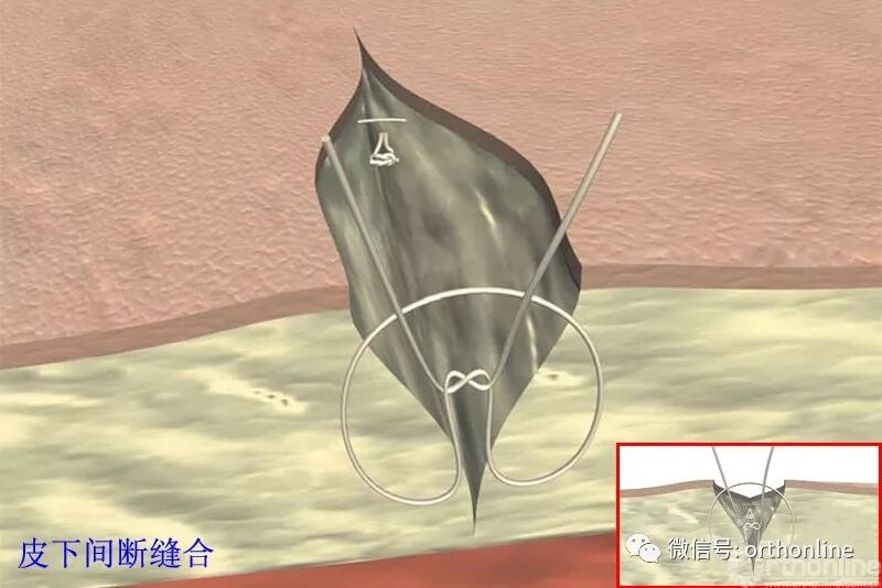 医疗缝线怎么做动图+视频，详解常见手术切口缝合技术_https://www.jmylbn.com_新闻资讯_第18张