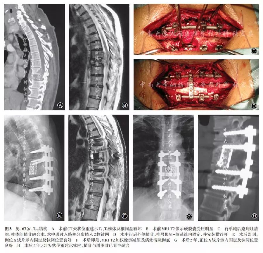 单纯后路单纯前路或前后联合入路治疗成人胸椎结核的中期疗效分析