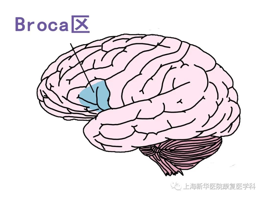 让您说不出话的失语症­——broca失语—— 新华科普560篇