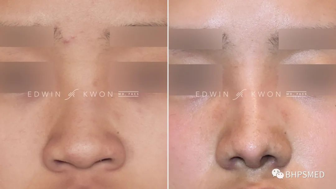 鼻形成術 Aesthetic Rhinoplasty 美容外科手術手技 裁断済 - 健康/医学