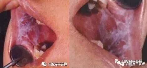 果不其然 口腔扁平苔藓真的能治好吗 口腔扁平苔藓 微信公众号文章阅读 Wemp