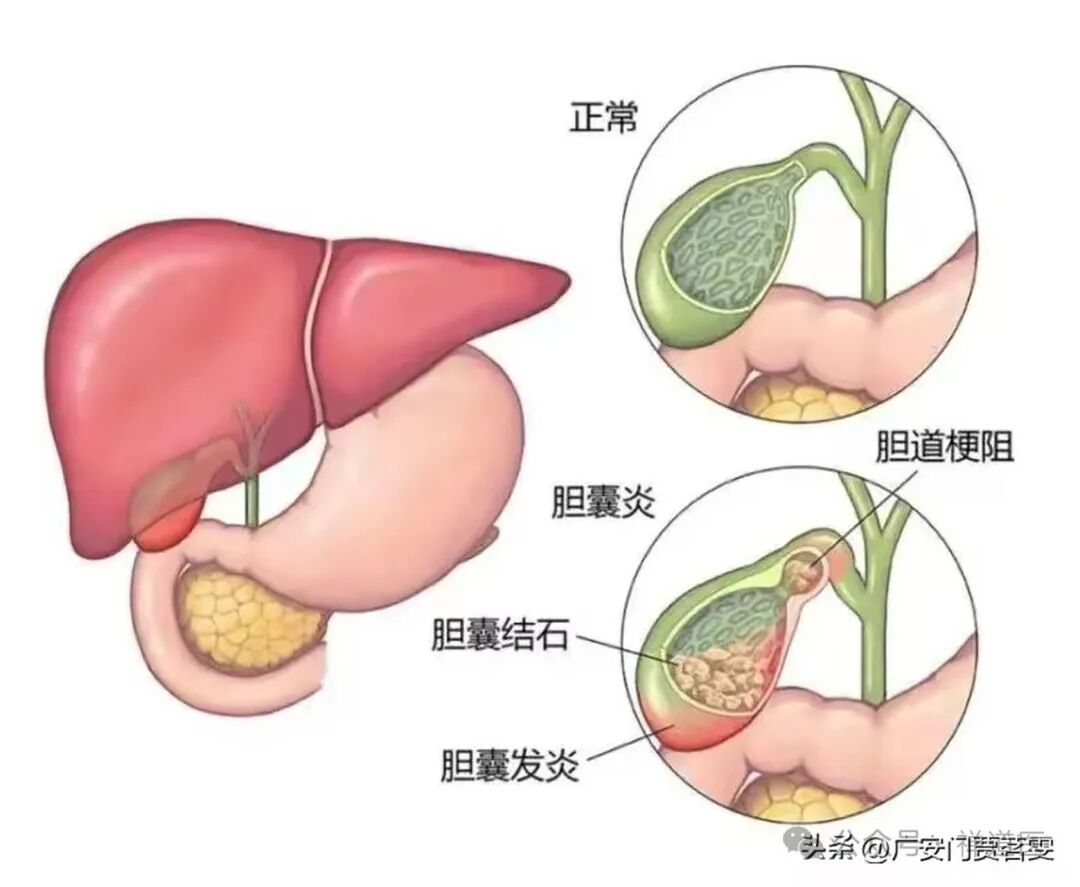 治疗胆囊炎、胆结石验方（名老中医魏长春）