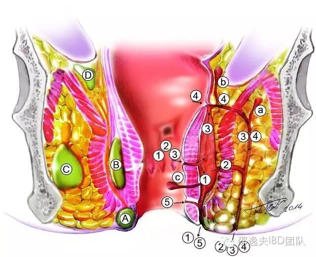 肛瘘是肛门直肠瘘的简称,简单来说,它是肛管与皮肤间的异常通道.