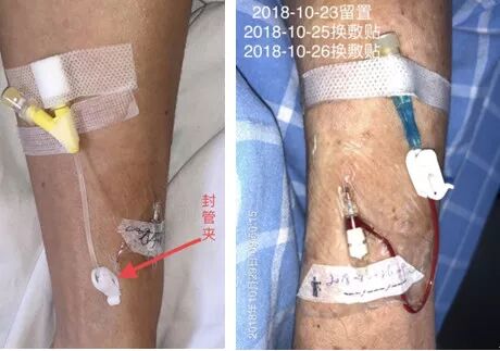 bd留置针怎么使用7大留置针固定要点，操作考试必掌握！_https://www.jmylbn.com_新闻资讯_第23张