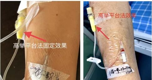 bd留置针怎么使用7大留置针固定要点，操作考试必掌握！_https://www.jmylbn.com_新闻资讯_第21张