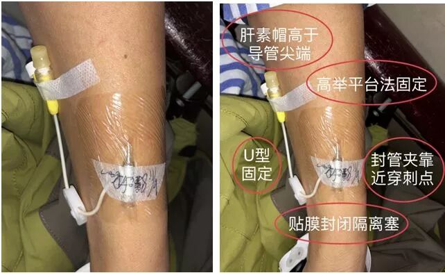 bd留置针怎么使用7大留置针固定要点，操作考试必掌握！_https://www.jmylbn.com_新闻资讯_第9张