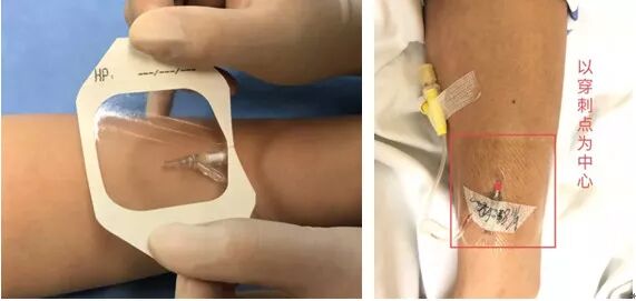 bd留置针怎么使用7大留置针固定要点，操作考试必掌握！_https://www.jmylbn.com_新闻资讯_第10张